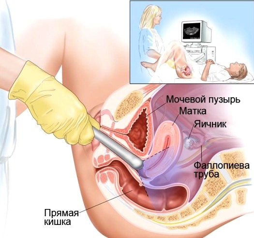 диагностика рака тела матки