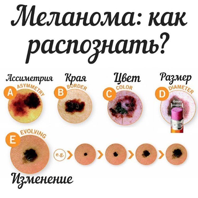 Меланома: диагностика и лечение в Минске