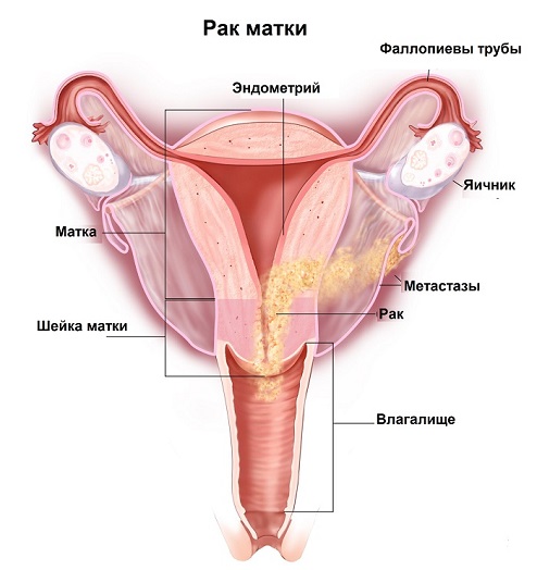 Рак тела матки: лечение и диагностика в Минске