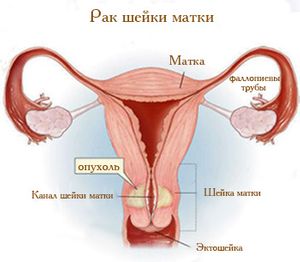 рак шейки матки