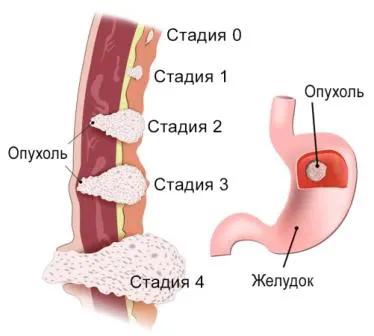 Рак пищевода: лечение, симптомы, диагностика плоскоклеточного рака - клиника ЛИСОД в Киеве, Украине