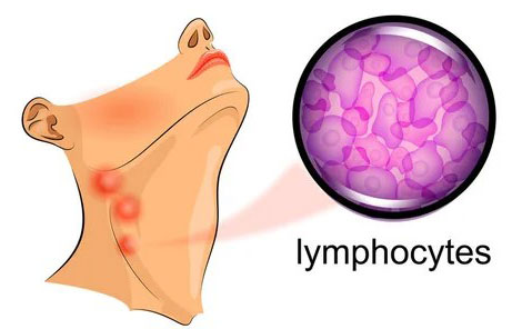 Лимфома - стадии заболевания