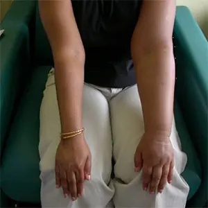 лимфедема руки