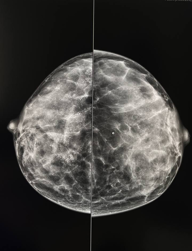 tsifrovaya mammografiya s 3d tomosintezom 1