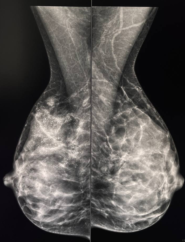 tsifrovaya mammografiya s 3d tomosintezom 2