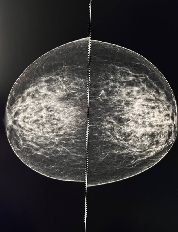tsifrovaya mammografiya s 3d tomosintezom 3