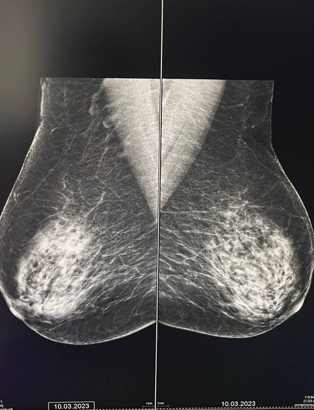 tsifrovaya mammografiya s 3d tomosintezom 4