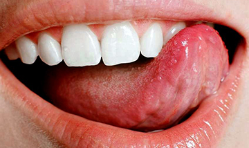Pikkelyes nyelv papilloma, HPV-fertőzés tünetei és kezelése