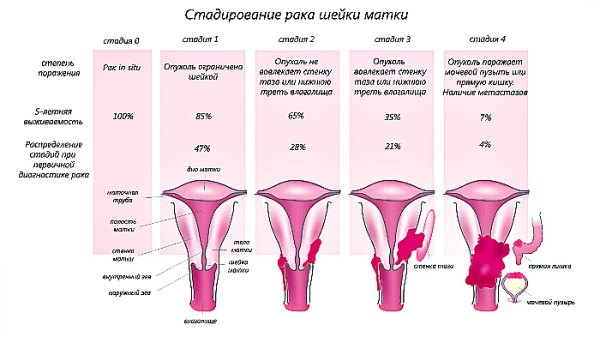 Рак шейки матки: правильное лечение