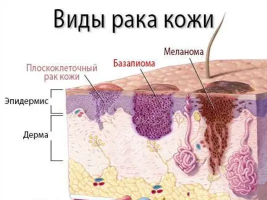 виды рака кожи