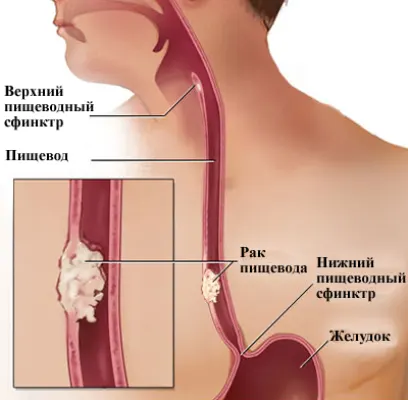 Рак гортани — первые признаки и симптомы, лечение онкологии гортани в Москве