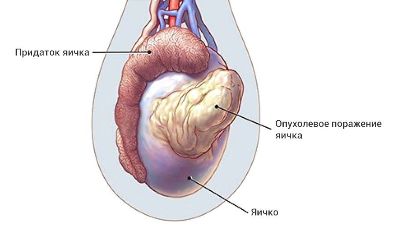 Анализ на ХГЧ - беременность: патология плода, хорионэпителиома, рак яичка