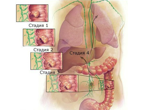 стадии рака ободочной кишки