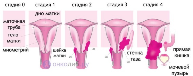 стадии рака тела матки